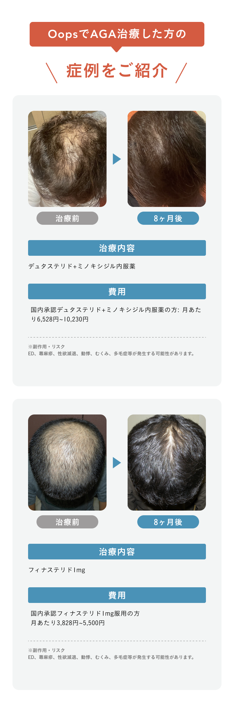 OopsでAGA治療した方の症例をご紹介